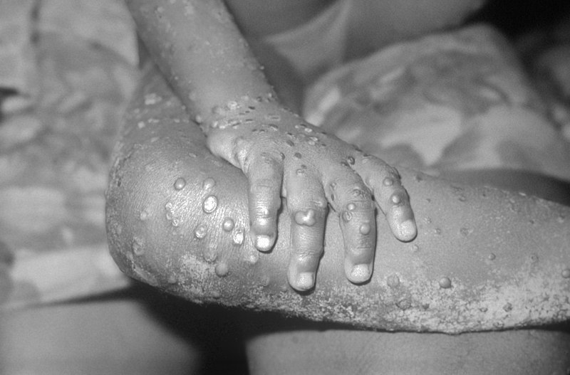 Close-up of monkeypox lesions on the arm and leg
